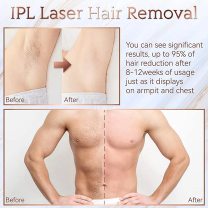 Smertefri IPL Laser Hårfjerning