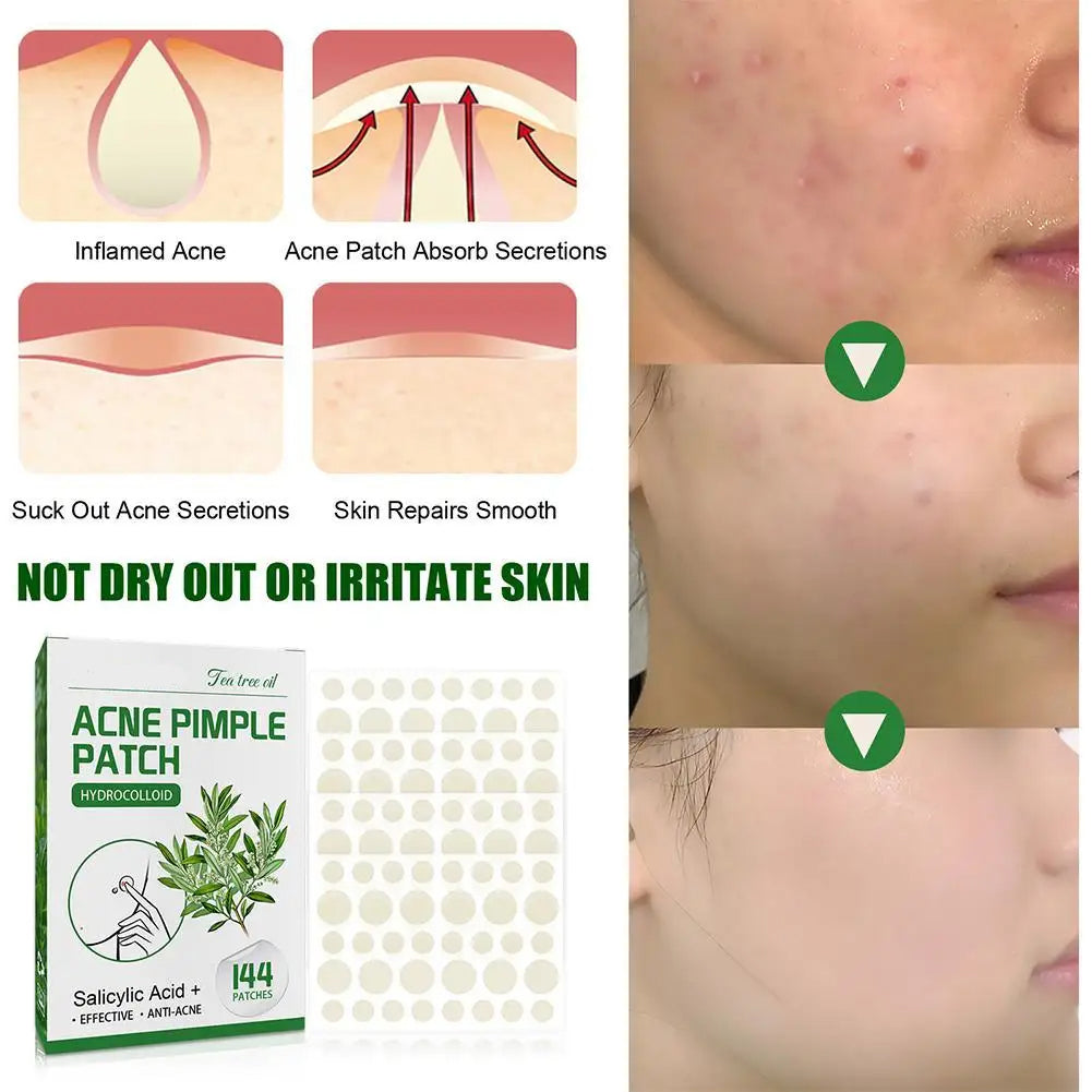 144 stk. Akne Pimple Patches med Salicylsyre