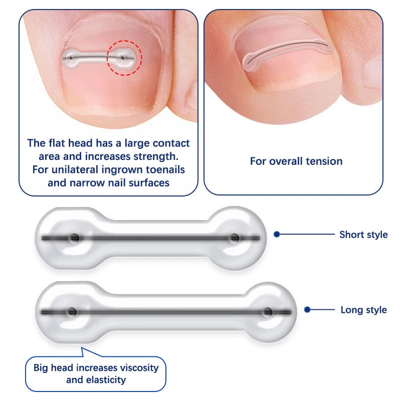 2 Stk. Nedgroet Tånegl Behandlingsplastre