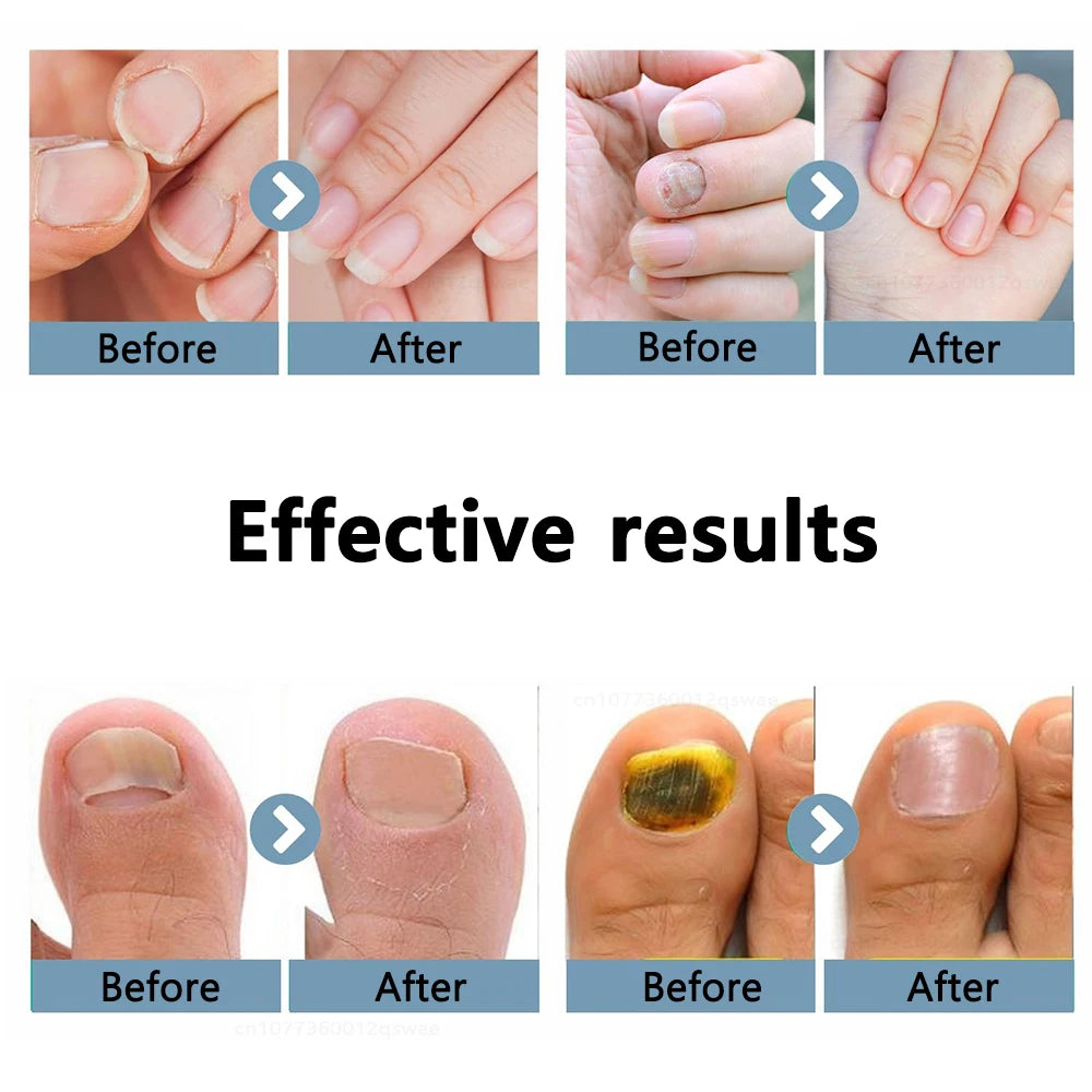 Lysterapi til Behandling af Neglesvamp