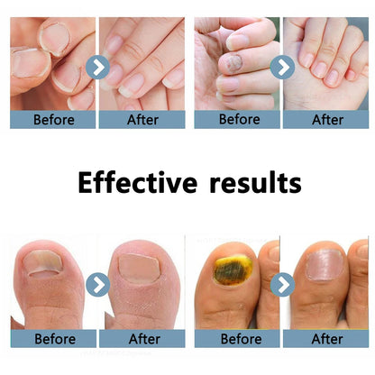 Lysterapi til Behandling af Neglesvamp