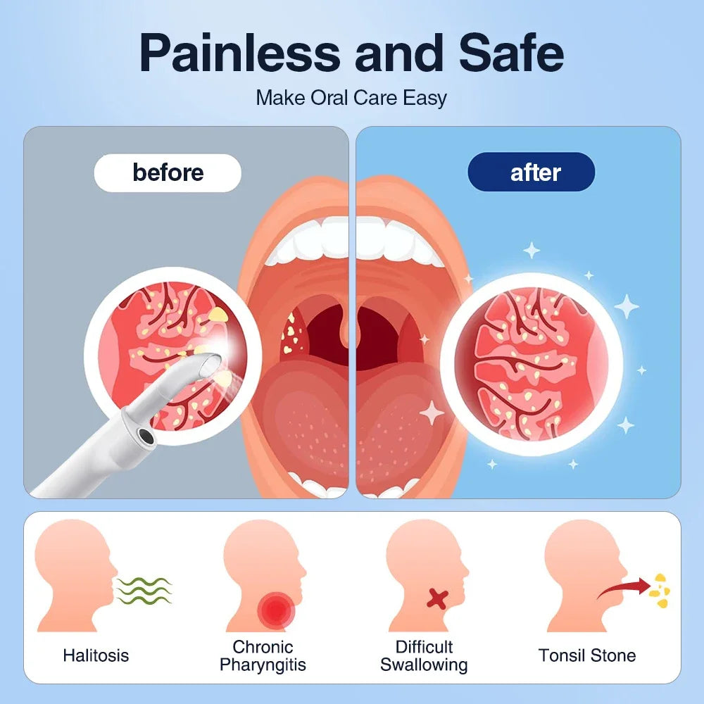 Elektrisk Tonsilstenfjerner med Sug
