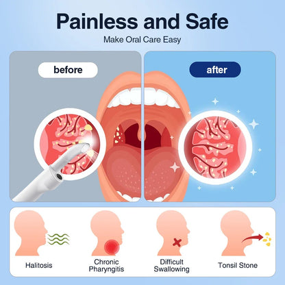 Elektrisk Tonsilstenfjerner med Sug