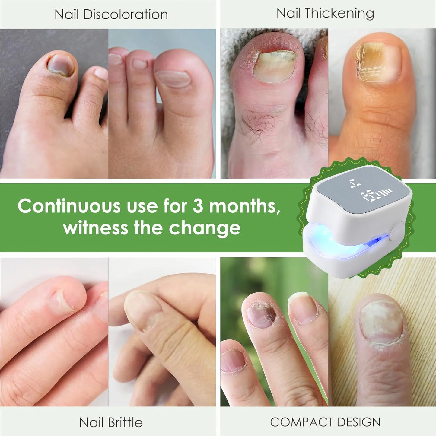 Laserterapienhed til Neglesvamp